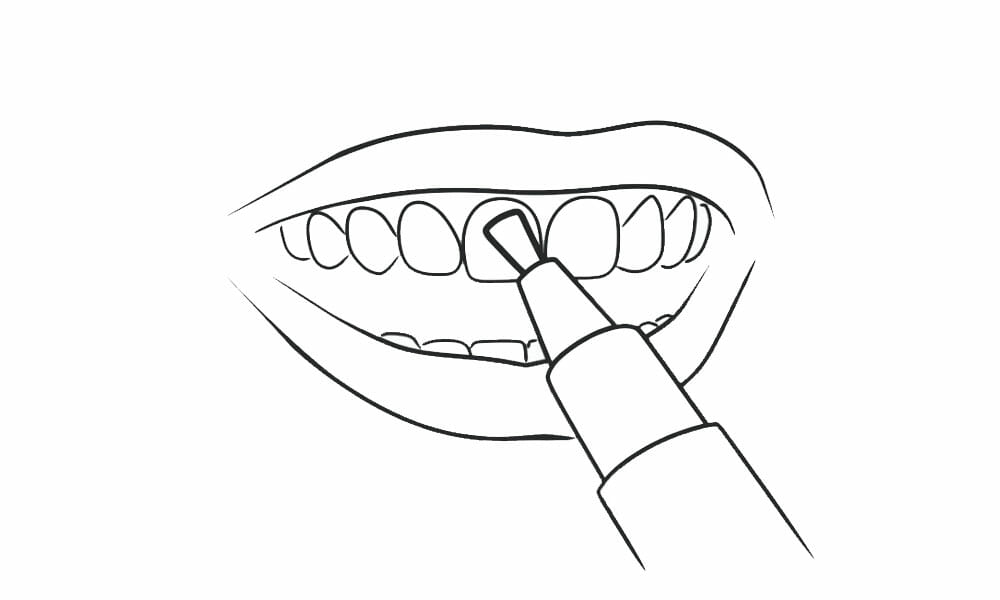 tandblekningspenna steg 3 applicering
